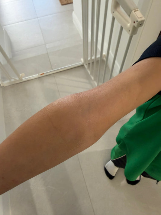 Healed eczema prone skin